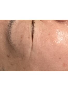 シミしわ改善！予防ケア