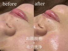 エーアール(ar)/お顔脱毛×毛穴洗浄