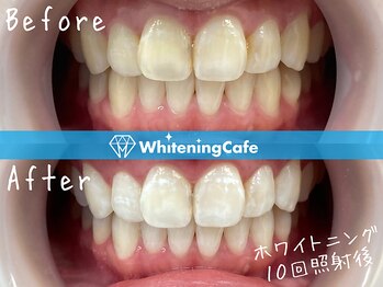 ホワイトニングカフェ 松本店(WhiteningCafe)/ホワイトニングビフォーアフター