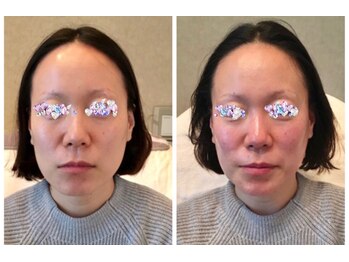 シベル(Si Belles)/30代後半/1回の結果