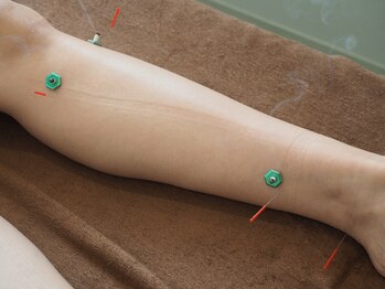 アネモネ 心斎橋院/サボテン美容鍼灸３