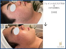 ひかり素肌/おひげ脱毛とフェイシャルエステ