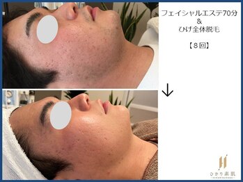 ひかり素肌/おひげ脱毛とフェイシャルエステ