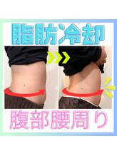 ヒーリングリゾート ナゴミ(Nagomi)/【脂肪冷却】1回施術