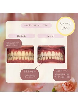 プラスビー 2号店(+b)/ホワイトニングビフォーアフター