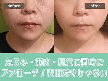 キザシ(kizashi)/超リフトで肌質まで変わる