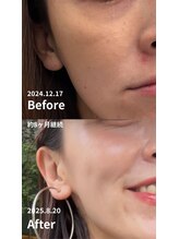 ニコ(nico)/before/after