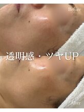 シューラディアント 金沢店(ShuRadiant)/リフトアップフェイシャル