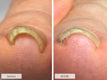 巻き爪改善ケア(初回→40分後)