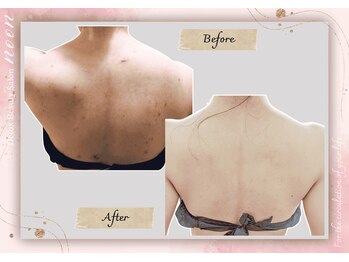 ヌーン(noon)の写真/駅から徒歩5分！エステ歴16年の技術で頑固な肩こり・慢性疲労を改善◎首・肩のつらさ解消へ♪