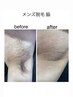 【美容ジェル使用＊エステのような美肌脱毛】男性 脇脱毛5,000円→3,500円