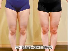 アンジー(Angie)/Ｏ脚がまっすぐに