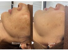 シャイニー/光フェイシャル１０回