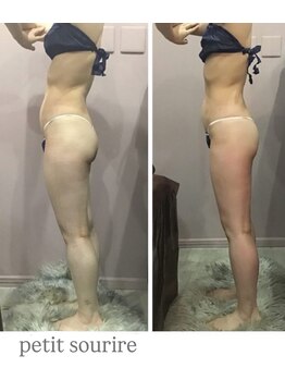 プティットスリール エステティック 栄本店(Petit Sourire Esthetic)/セル撃退マシン(カッピング)