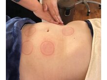 真心美/腸活スライドカッピング