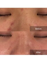 ラヴニール(L'avenir)/ニキビの色素沈着を艶肌へ