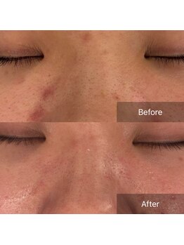 ラヴニール(L'avenir)/ニキビの色素沈着を艶肌へ