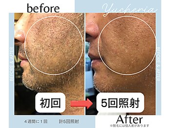 ユシェリア(Yucheria)/ひげ脱毛経過