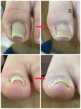 名古屋駅前巻き爪センター/巻き爪