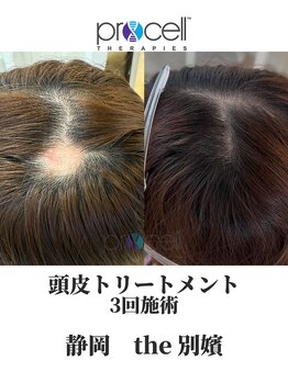 ザ ベッピン(the 別嬪)/頭皮は提携美容院にて施術可能