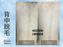 アルゴ 山口宇部店(ALGO)/ショット数4倍！効果抜群！