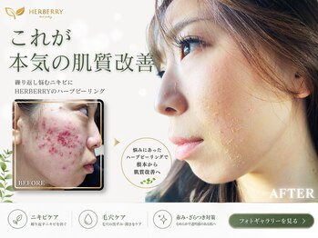ハーバリー 天王寺(HERBERRY)の写真/【ハイドラピーリング×ハーブピーリング】どんな施術よりも圧倒的★凸凹肌毛穴洗浄毛穴黒ずみの変化に感動
