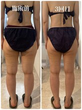 ティティー(tity)/下半身痩身モニター様