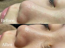 シル 長岡天神店(cils)/毛穴洗浄