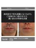 【夏直前！美肌全身脱毛】美肌お仕上げまで込み50％off！￥20000→