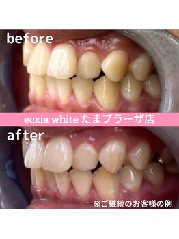 エクシアホワイトニング たまプラーザ店/ビフォーアフター
