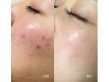 パールフェイスエステ ルペルル(PEARL FACE ESTHE la perle)の雰囲気（ニキビケアに肌質改善をサポート）