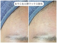 フラックス 京都(FLUX)/【ワックス脱毛】額