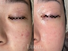 ルオン(Luon.)/ハーブピーリング/20代女性