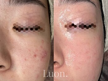 ルオン(Luon.)/ハーブピーリング/20代女性