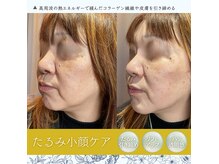 美肌洗浄/ヘッドトリートメント/サーマガン◎リフトアップ重視