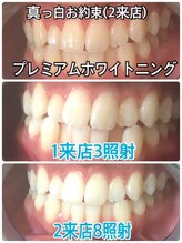 ホワイトニングビューティー 吉祥寺店/症例写真_2回来店されたお客様