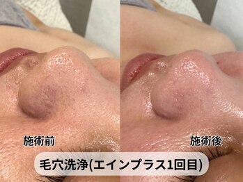 アルピナ(ALPINA)の写真/黒ずみ・開き・たるみ毛穴改善!本格毛穴洗浄フェイシャル