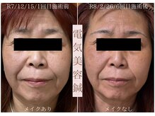 鍼灸院オリーブ(鍼灸院OLIVE)/美容鍼でたるみケアと小顔へ導く