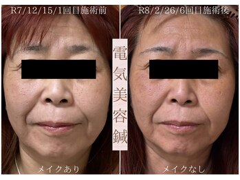 鍼灸院オリーブ(鍼灸院OLIVE)/美容鍼でたるみケアと小顔へ導く