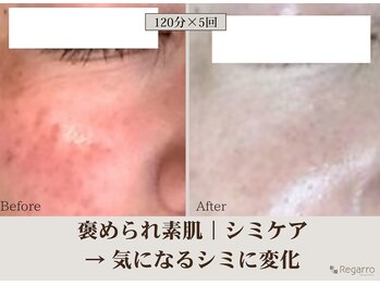 レガロビューティクリエイションズ桜川店/褒められ素肌│シミケア