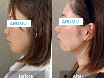 アルム コリア(ARUMU KOREA)/人気NO.1水光ピーリング