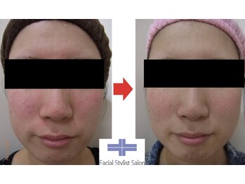 フェイシャルスタイリストサロン 四谷店/ケア例(5)