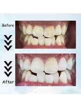 エクシアホワイトニング 塩釜口駅前店/２０代半ばの男性の効果事例