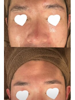 ミベル フェイシャルサロン(MIBELL FACIAL SALON)/お客様症例★メンズ