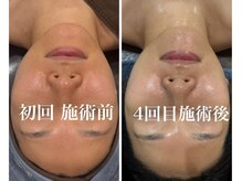 小顔 ツヤ肌/シミくすみ毛穴たるみハリ感