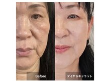 リーシャ(Reesha)/ダイヤモンドピールプログラム