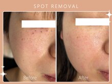 ハノハノ 八代店(HANO HANO)/気になるシミ、何個でもぺろん☆