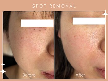 ハノハノ 八代店(HANO HANO)/気になるシミ、何個でもぺろん☆