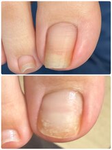 シュガーズネイル(sugar's nail)/巻き爪ケア