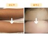 【子ども脱毛】6歳からはじめられる優しい脱毛!無料相談＆パッチテスト